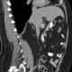 Lipoma in duodenum, small: CT - Computed tomography